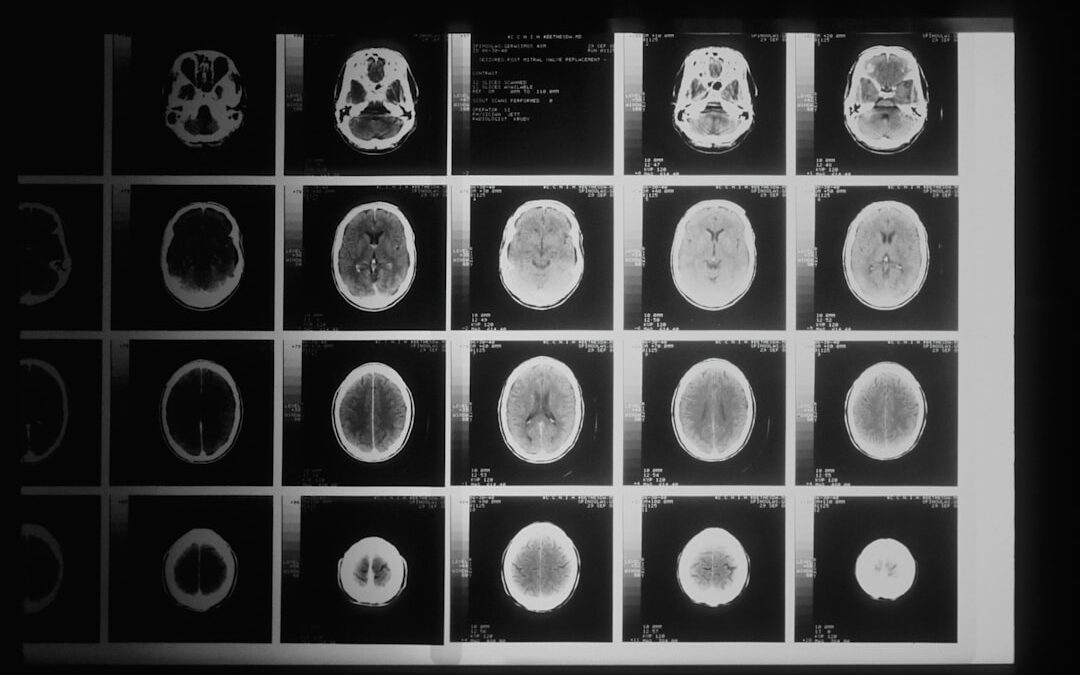 This Problem Can Be an Early Alzheimer’s Warning Sign